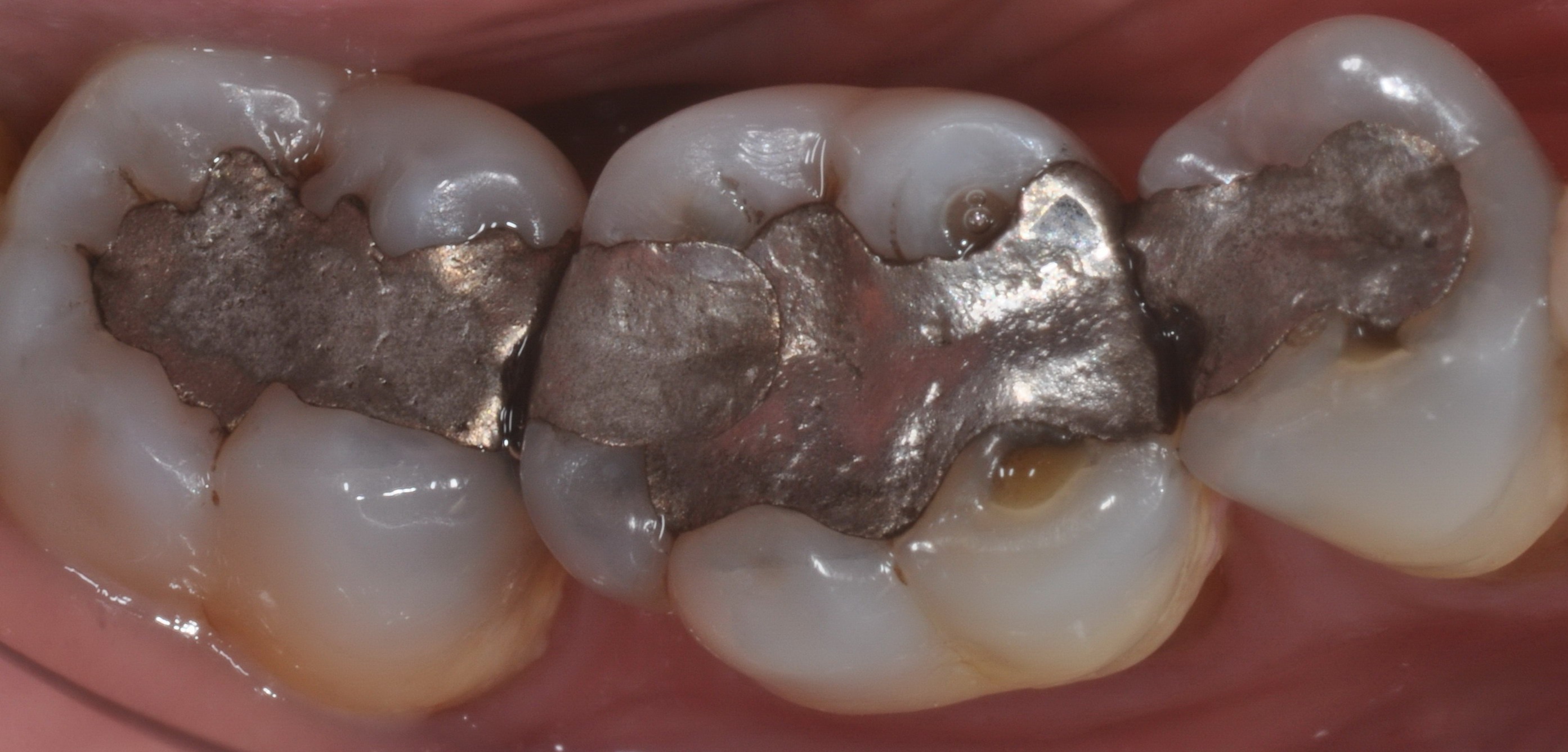 Otturazioni in amalgama sostituite con restauri Indiretti (intarsi) in ceramica