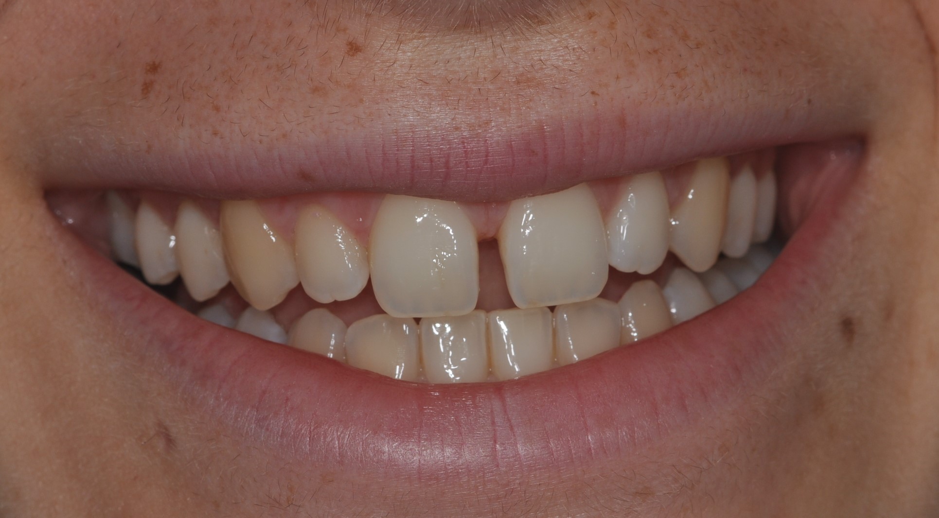 Chiusura Diastema tramite Faccette