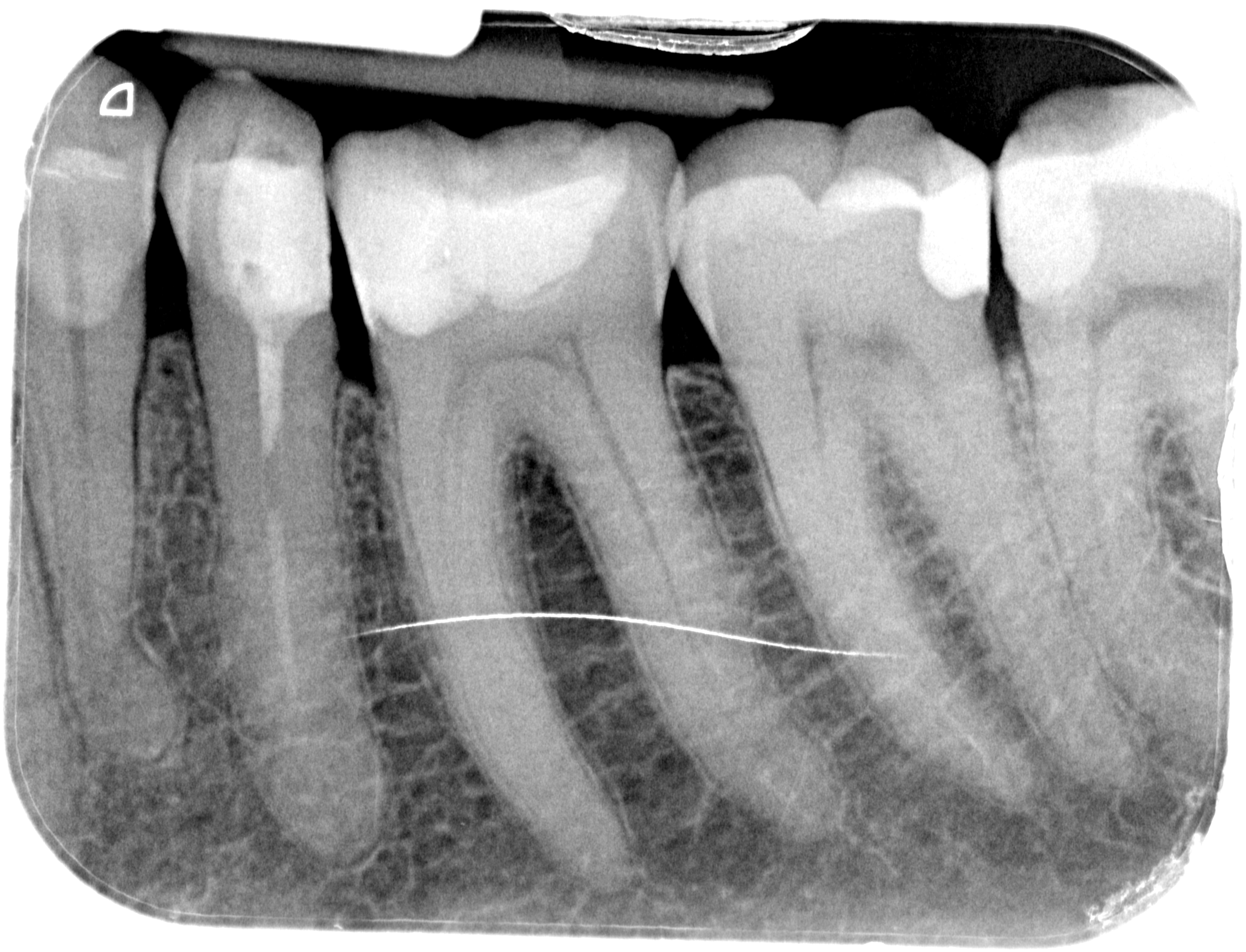 Ritrattamento Endodontico