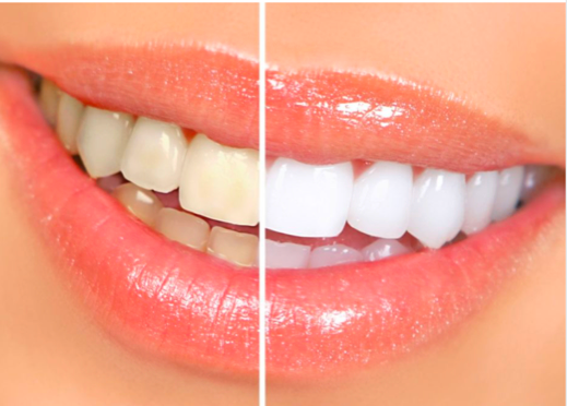 Sbiancamento Dentale