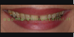 CASO PROTESI FISSA ESTATICA IN CERAMICA INTEGRALE