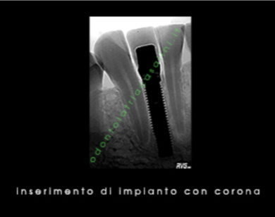 CASO CHIRURGIA IMPLANTARE