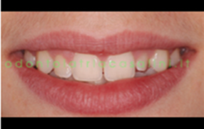 Sbiancamento Dentale