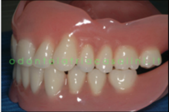 Protesi totale rimovibile